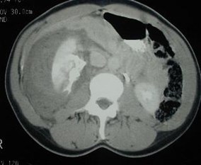 Blunt injury abdomen dissertation